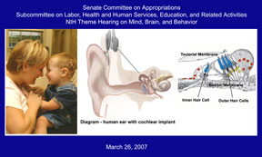 Thumbnail of cochlear implant illustrations; click to view full-size image