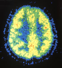 Color slide of a PET scan of a normal brain