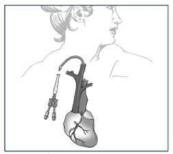 Drawing of a venous catheter inserted through the skin near the collarbone. The catheter is connected to the large vein from the heart. The other end of the catheter branches into two portals.