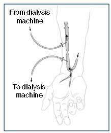 Drawing of the underside of a forearm with an arteriovenous fistula. Arrows show the direction of blood flow. Two needles are inserted into the fistula. Labels explain that one needle carries blood to the dialysis machine and the other needle returns blood from the dialysis machine.
