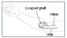 Drawing of an arm with an arteriovenous graft at the bend of the arm. Labels point to an artery and a vein. A curved tube, labeled looped graft, connects the artery to the vein. Arrows show the direction of blood flow from the artery to the vein through the looped graft.