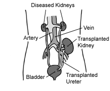 Illustration of a transplanted kidney.