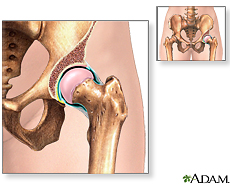 Illustration of the hip joint