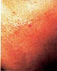 Mild acne vulgaris