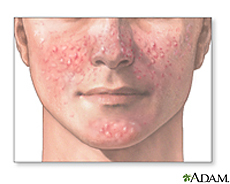 Illustration of facial acne