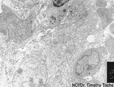 Photograph of soft tissue sarcoma viewed through an electron microscope