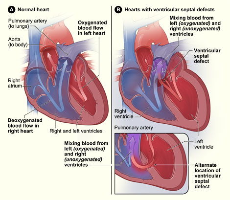 Heart cross section with VSD