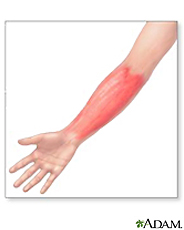 Illustration of cellulitis on the arm