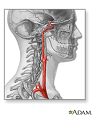 Illustration of a carotid artery