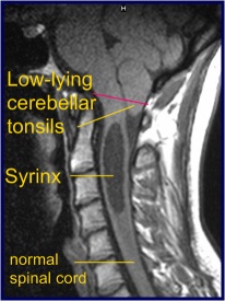 An MRI showing the Chiari Malformation in addition to a syrinx.