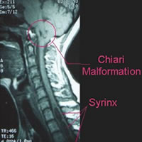 An MRI with Chiari Malformation and syringomyelia highlighted.