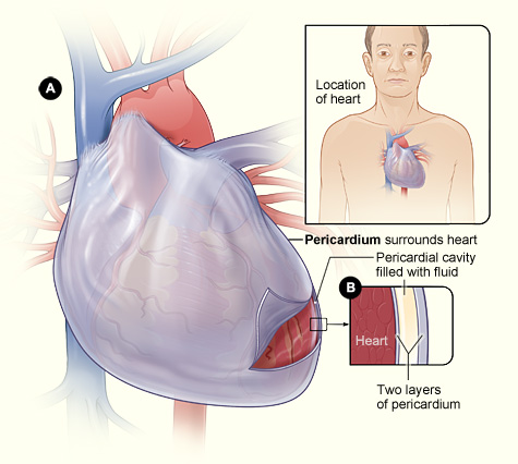 The image displays Figure A and Figure B. Figure A shows the sac surrounding the heart.  Figure B is an enlargeed cross-section of the pericardium which displays two layers of tissue and the fluid between the layers.
