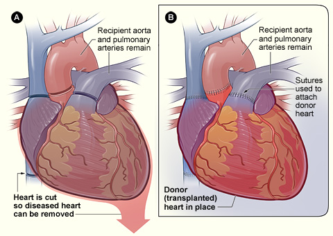 Illustration of a Heart Transplant