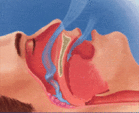Diagram of the anatomy of sleep apnea. - Click to enlarge in new window.