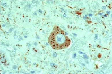 Rabies virus infected neuronal cell