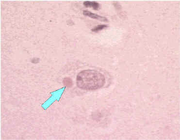 Negri body in infected neuron