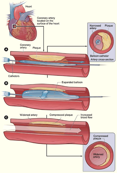 Illustration showing coronary angioplasty to restore blood flow through a narrowed or blocked artery in the heart using a thin tube with a balloon which is threaded through a blood vessel up to the site of a narrowing or blockage in a coronary artery where it is then inflated to push the plaque outward against the wall of the artery, widening the artery and restoring the flow of blood through it.