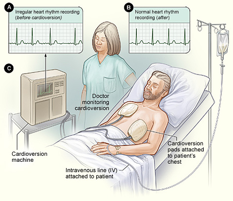 The illustration shows a typical setup for a nonemergency cardioversion. Figure A shows an irregular heart rhythm recording (before the cardioversion). Figure B shows a normal heart rhythm recording (after the cardioversion). Figure C shows the patient lying in bed with cardioversion pads attached to his body. The doctor closely watches the procedure.