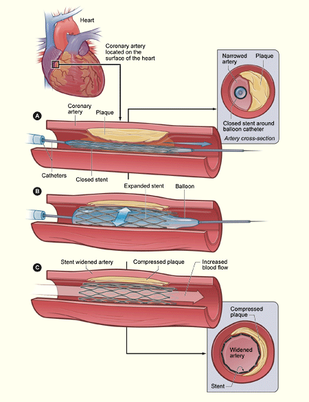 The illustration shows the placement of a stent in a coronary artery with plaque buildup.