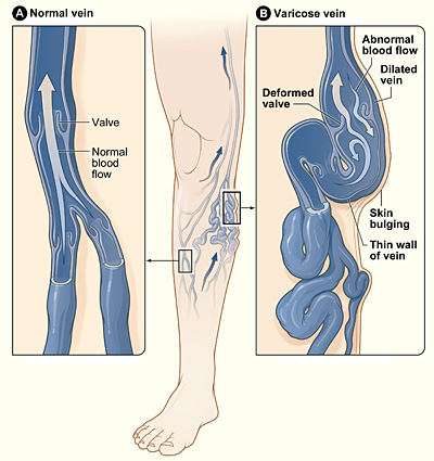 The illustration shows the location of leg veins