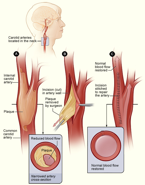Illustration showing the process of carotid endarterectomy, including plaque buildup, a cross-section of the narrowed carotid artery, how the carotid artery is cut and the plaque removed, and the artery stitched up and normal blood flow restored.