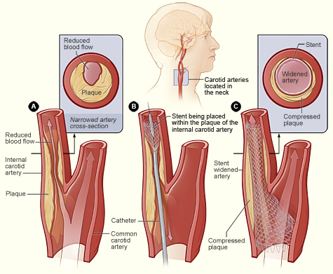 Illustration showing the process of carotid artery stenting, including a cross-section of the narrowed carotid artery, a stent being placed in the carotid artery, normal blood flow restored in the stent-widened artery, and a cross-section of the stent-widened artery.