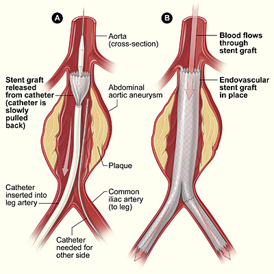 The illustration shows the placement of an endovascular stent graft in an aortic aneurysm. In figure A, a catheter is inserted into an artery in the groin (upper thigh). It is then threaded up to the abdominal aorta, and the stent-graft is released from the catheter. In figure B, the stent-graft allows blood to flow through the aneurysm.