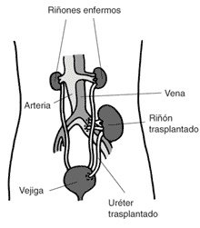 La ilustración de un riñon trasplantado