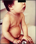 This is an 11 mo. old infant with a mild rubella rash, as well as a nondescript secondary macular eruption.