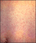 This patient presented with a generalized rash on the abdomen caused by German measles (rubella).