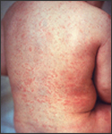 Rash of rubella on skin of child's back.