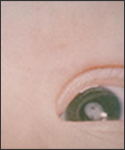 This photograph shows the cataracts in a child’s eyes due to Congenital Rubella Syndrome (CRS).