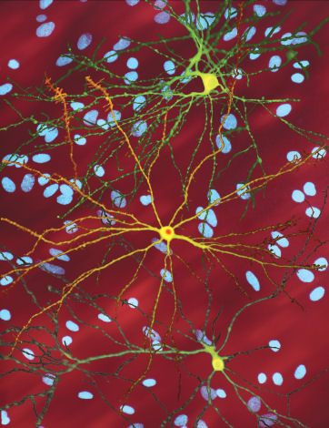 A montage of three images of single striatal neurons transfected with a disease-associated version of huntingtin, the protein that causes Huntington's disease.