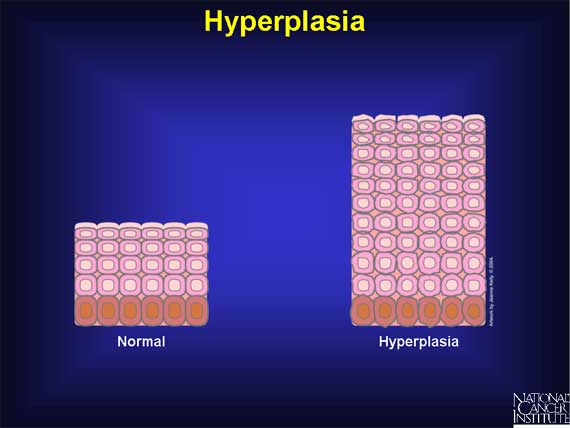 Hyperplasia