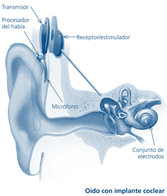 
Oído con implante coclear