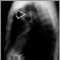 Pulmonary mass - side view chest X-ray