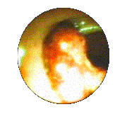 photo of polyps seen through sigmoidoscopy