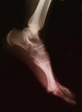 Fotografía de una radiografía del pie