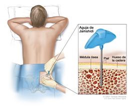 Aspiración y biopsia de la médula ósea;  el dibujo muestra a un paciente acostado boca abajo en una camilla y una aguja de Jamshidi (una aguja larga y hueca) que se inserta en el hueso de la cadera. El recuadro muestra la aguja de Jamshidi que se inserta a través de la piel hasta la médula ósea del hueso de la cadera.