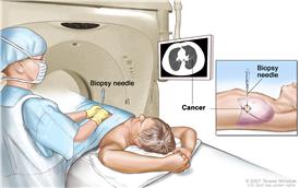 Lung biopsy; drawing shows a patient lying on a table that slides through the computed tomography (CT) machine with an x-ray picture of a cross-section of the lung on a monitor above the patient. Drawing also shows a doctor using the x-ray picture to help place the biopsy needle through the chest wall and into the area of abnormal lung tissue. Inset shows a side view of the chest cavity and lungs with the biopsy needle inserted into the area of abnormal tissue.