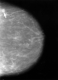 Mammogram showing small cancerous lesion. - Click to enlarge in new window.