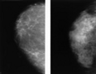 Side by side view of two normal breasts. - Click to enlarge in new window.