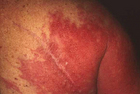 Shingles rash on shoulder and back. - Click to enlarge in new window.