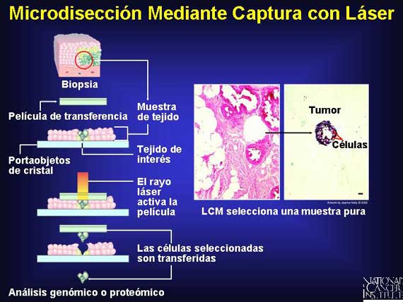 Microdisección Mediante Captura con Láser