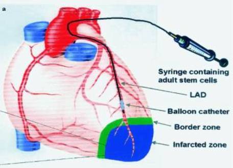 Figure 2. Intracoronary Administration