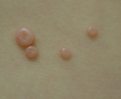 Close-up view of typical molluscum bumps.