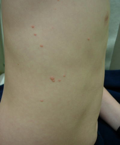 Typical molluscum lesions on the torso of a child.