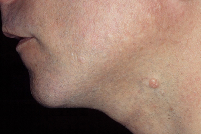 Single molluscum bump on the neck of an adult man.