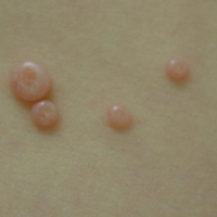 Close-up view of typical molluscum bumps. Typical bumps are approximately 3-5 mm in diameter.