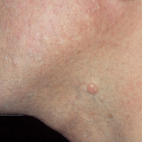 A single molluscum bump on the neck of an adult man. Typical bumps are approximately 3-5 mm in diameter